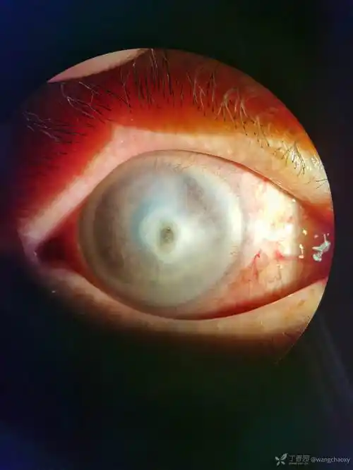 这种角膜溃疡各位都怎么处理呢