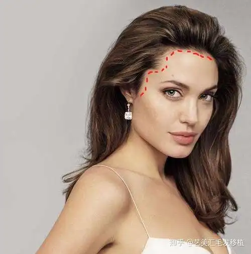 女性发际线想要植好必须做到这几点
