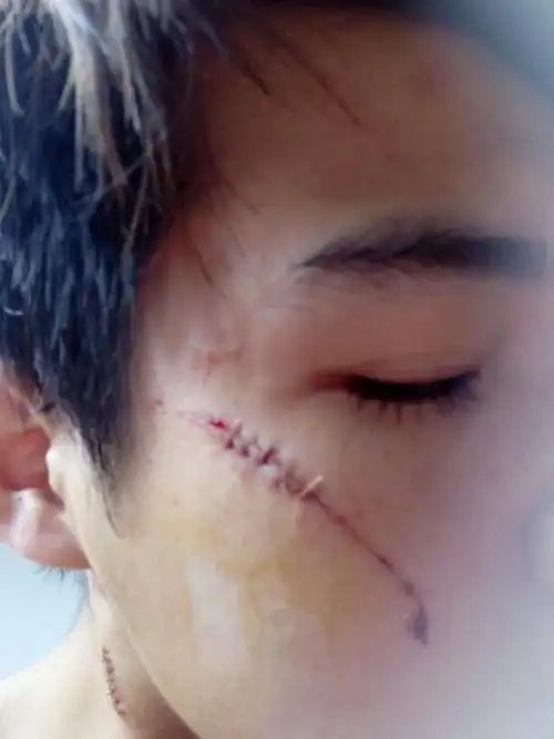 昨天脸被刀砍伤会不会留伤疤,如果留了怎么保养或者修复.