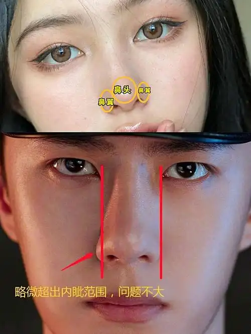 干货大鼻翼宽鼻头如何拯救