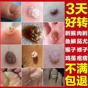 祛刺猴肉刺鱼鳞痣膏除手上去猴子肉粒疙瘩贴瘊子药手部跖疣灵正品