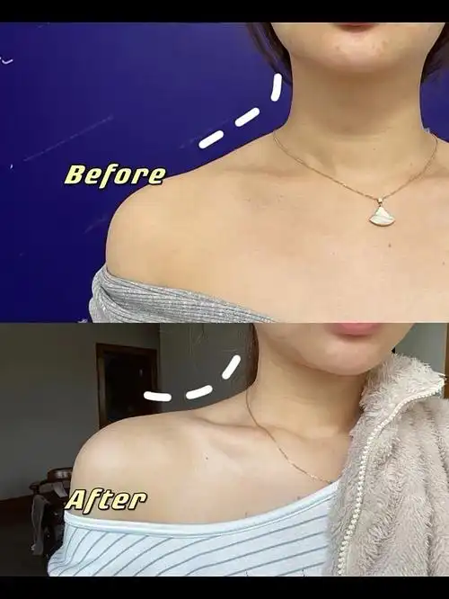之前斜方肌比较厚实,打完瘦肩针半个月后,肩部明显变_圈子-新氧美容