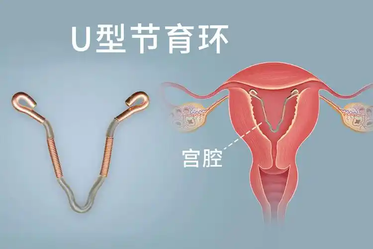 是一种避孕效果好,作用时间长的宫内节育环