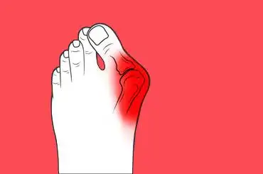 拇外翻会造成哪些并发症