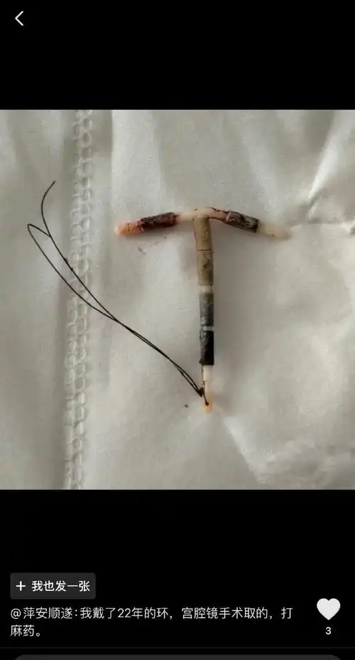 女性子宫内取出来的各种形状的避孕环.