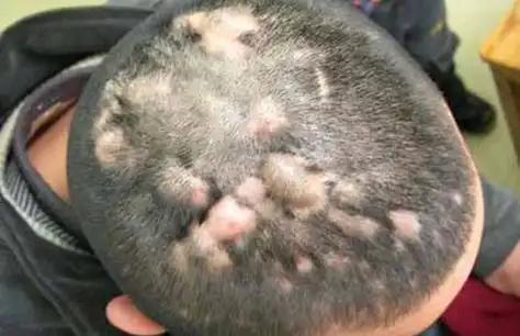 春季是毛囊炎的高发季,那毛囊炎成绩如何处理?