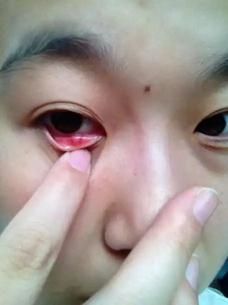 眼睛下眼睑长了一个肉疙瘩.不痛.但是手摸有存在感.求帮助!