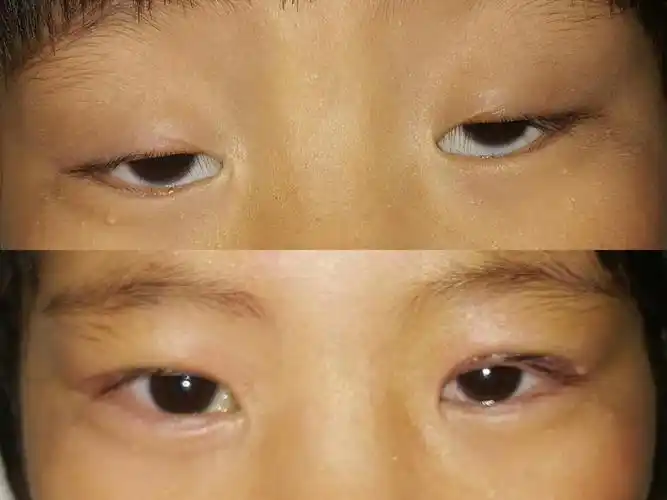 先天性上睑下垂 - 好大夫在线