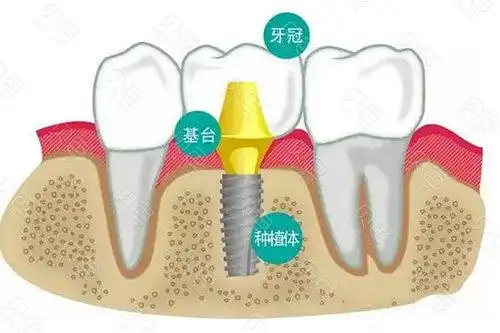 分段种植牙结构分析图