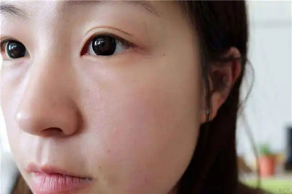 毛孔粗大医美能解决吗