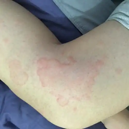 夏天真的是个和荨麻疹约会的好时候