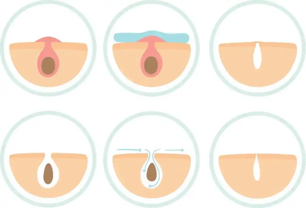 为什么毛孔越来越大?