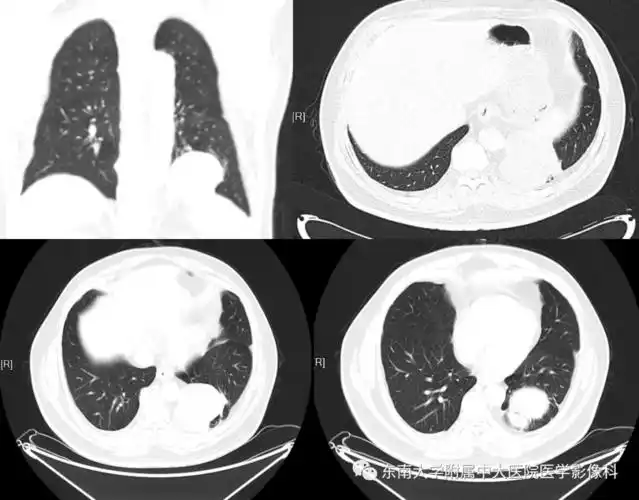08.04 呼吸系统疾病——肺隔离症