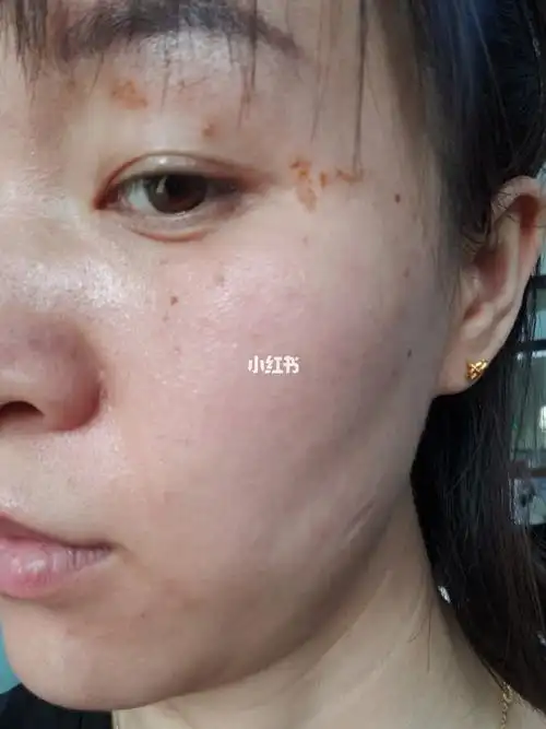 碘伏治疗扁平疣_补气血_维生素b_眼镜_医疗健康_医疗健康其他