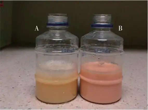 首发表现为双侧乳糜胸的胸腺瘤1例