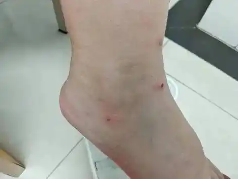 一家四口,全部确诊!_蚊虫_蠓虫_丘疹