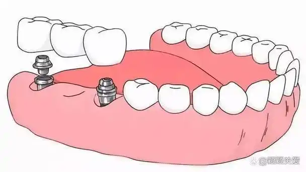 缺牙患者在了解种植牙诊疗时可能会听到这样的介绍种牙当天晚上就能啃