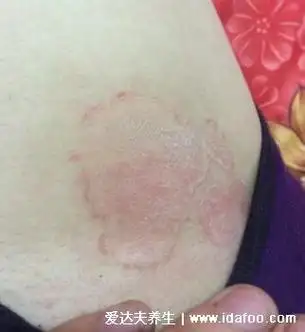 初期女性股癣图片及症状,大腿肚内侧长环状红斑有剧烈瘙痒