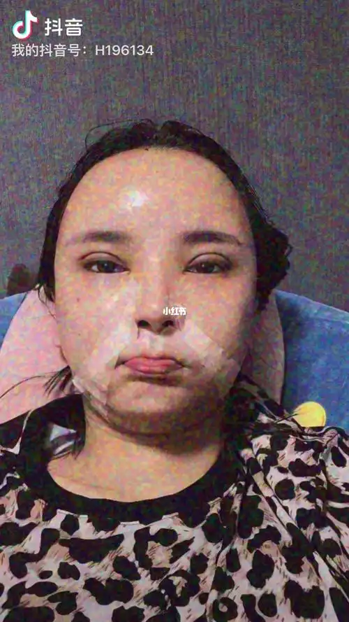 双眼皮77脂肪填充第3天.我的妈呀还是很肿  好丑  好像快快消肿.