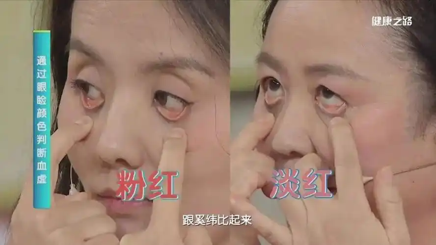 视察本身的面色,若是发现面白无华,面色萎黄,解说测试者属于贫血体质