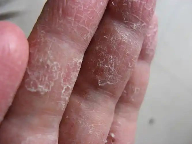 手感觉热 痒然后皮肤就变硬 之后脱落 尤其食指是什么病 怎么治 求