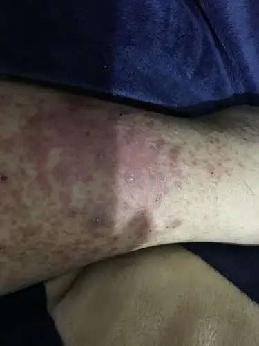 一开始腿上长了几个小包 有时痒 挠了破养了挠