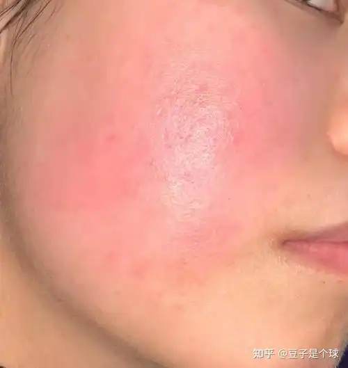 我不说谁知道我原来是个大红脸,脸过敏,脱皮的"玫瑰女孩"呢!