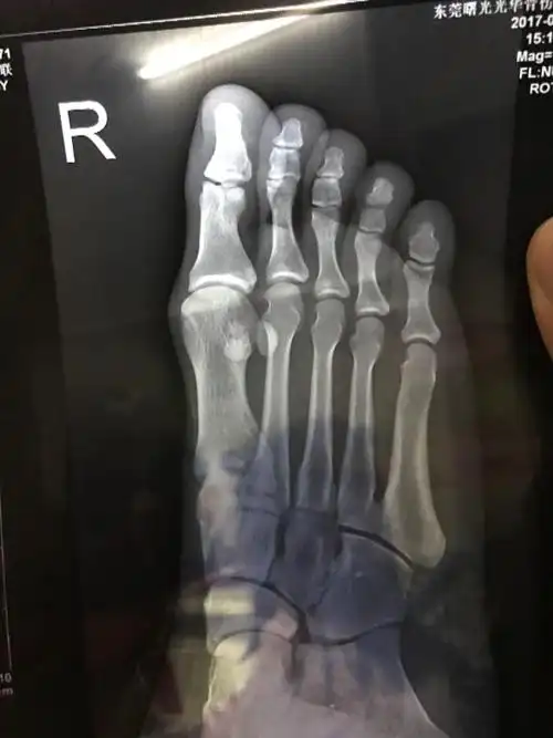 请教下是第四脚趾骨骨折吗?