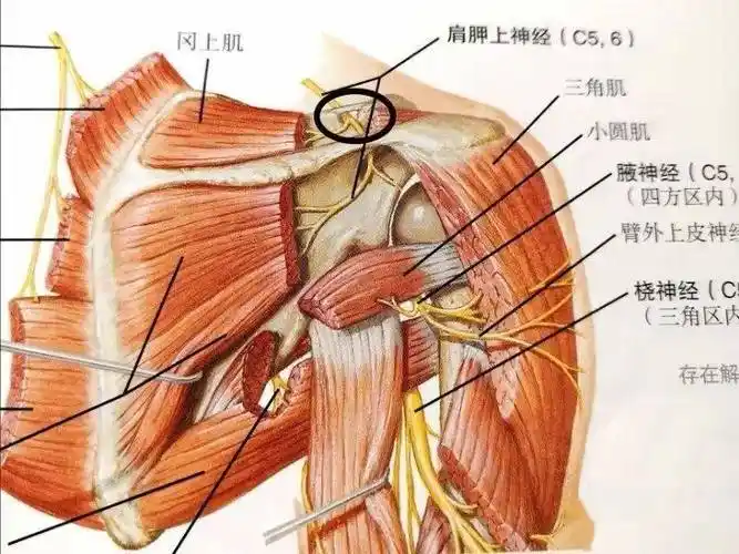 肩胛上神经卡压