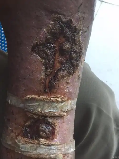 各位同仁帮看看这个是皮肤癌还是恶性溃疡 - 皮肤和性疾病资源版 - 爱