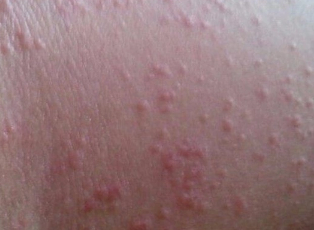 如果皮肤出现湿疹症状,但不确定是否是湿疹,建议去皮肤科进行专业检查