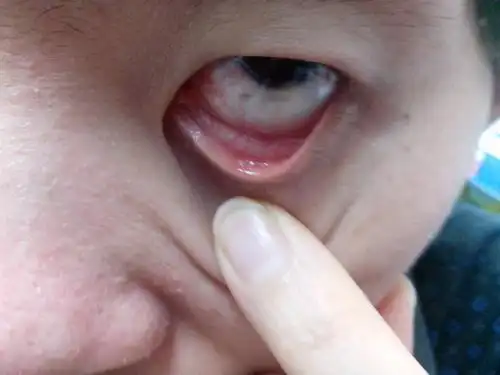 麻烦帮我看下眼皮下方长的白点 是什么应该怎样治疗 有些磨眼球 谢谢