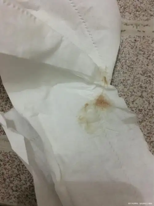 谁有过排卵期出血的