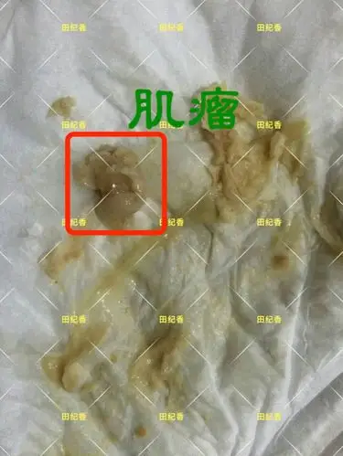 其它 如果你有妇科疾病,了解田纪香的请进 写美篇肌瘤如果不排医院