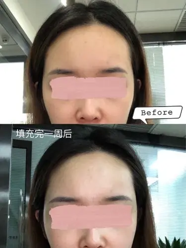 05今天是太阳穴填充完婕尔玻尿酸第7天