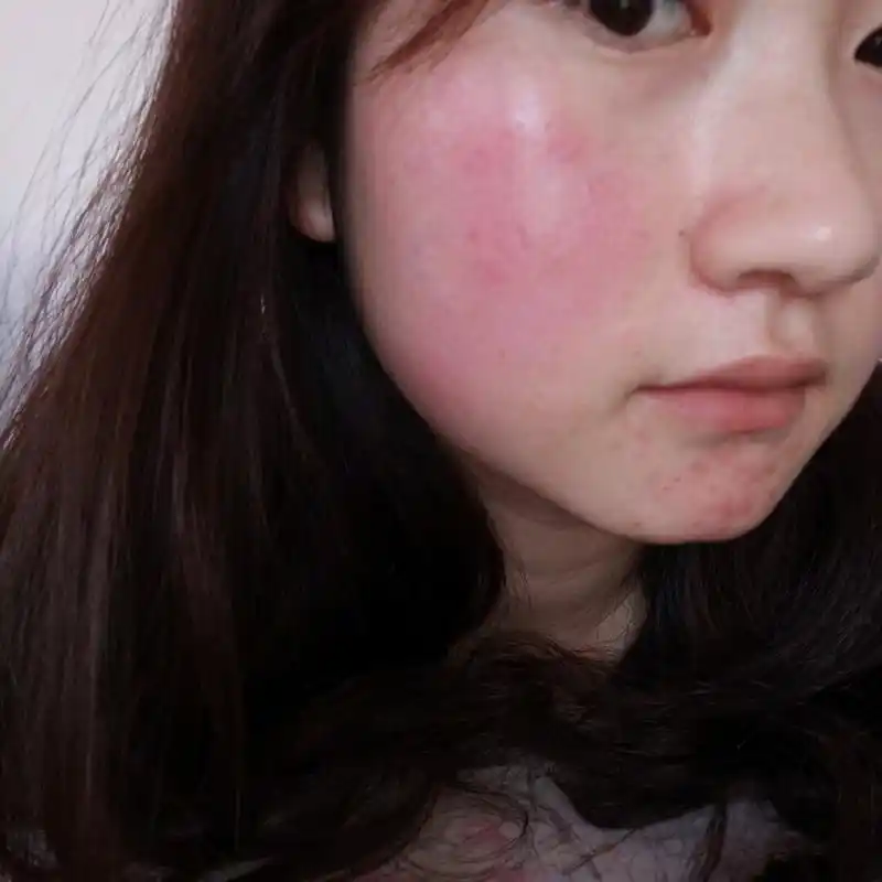 敏感肌红血丝 激素皮炎