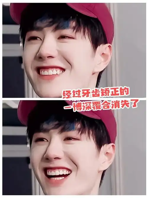 王一博又双叒叕整容了?