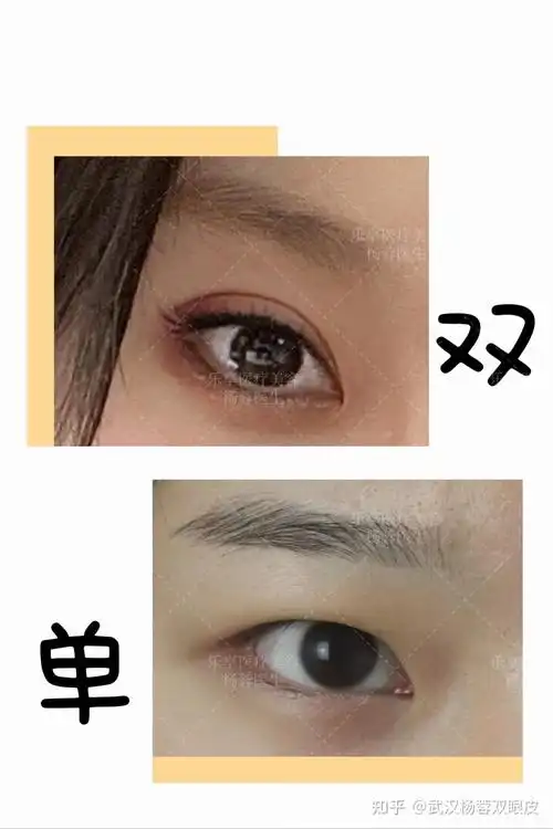 双眼皮可以改成单眼皮吗