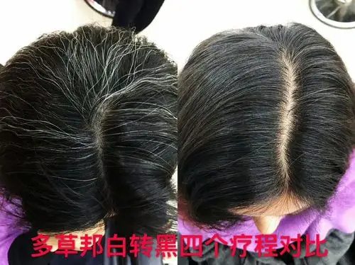中科多草邦白发转黑发四个疗程对比图