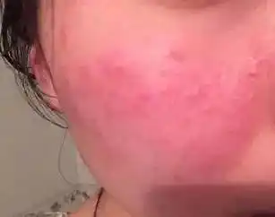 脸部过敏是很常见的问题,严重会引起瘙痒红肿,疼痛!