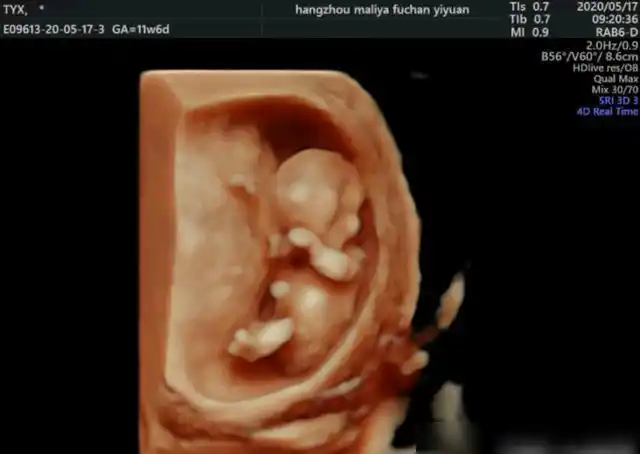 关于nt检查,孕妈妈孕13周前一定要看|羊水|胎儿|b超|穿刺|孕妇_网易