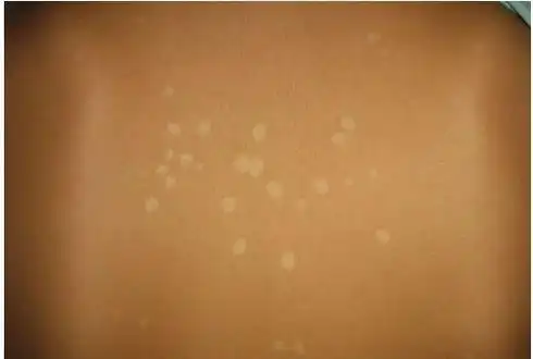 花斑癣危害不容小觑_金华婺城皮肤病防治院【官网】