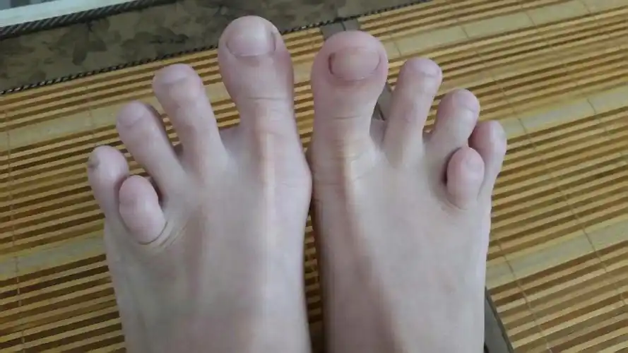 谁能告诉我为什么我两个倒数二的小脚趾长这样的?