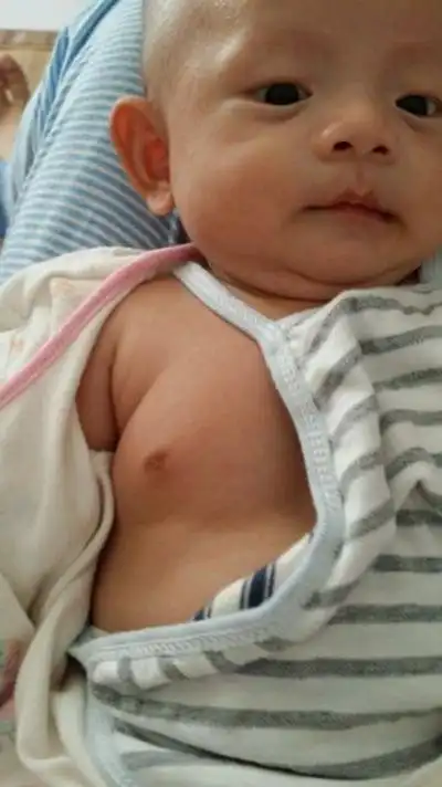 儿童性早熟图片50