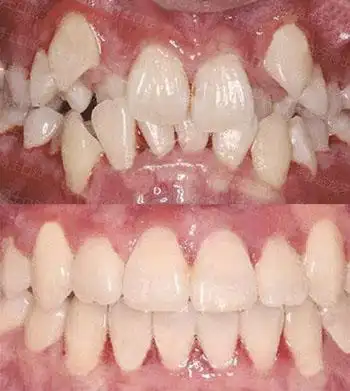 牙齿矫正前后对比照