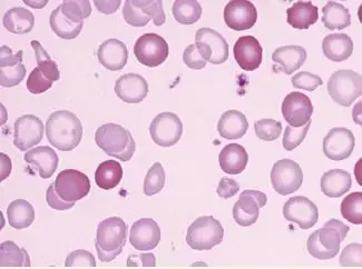 科普预防缺铁性贫血_红细胞