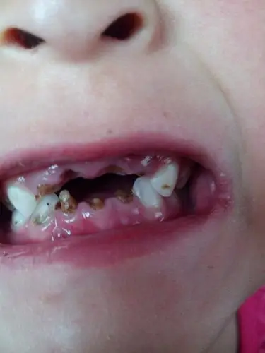 严重龋齿的图片_有来医生