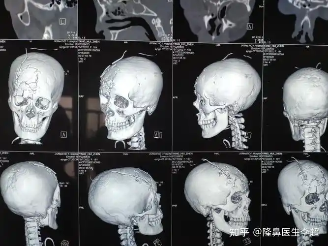 浅谈binder综合症一种你可能没听说但绝对熟悉的颅颌面疾病