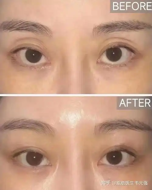 脂肪填充术前术后对比这是求美者做完上睑自体脂肪填充后1个月的照片