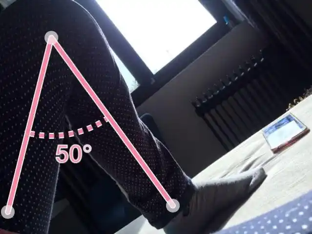 热敷后弯曲角度130° (术后25天)